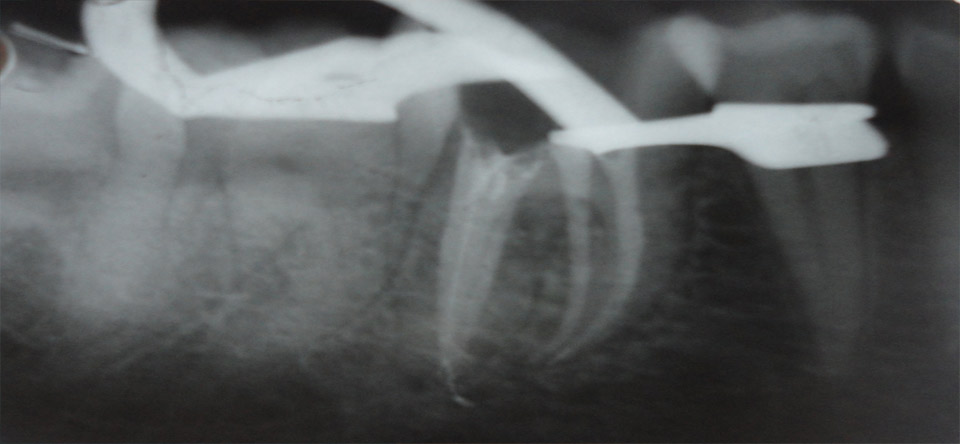 Single Visit Painless Root Canal