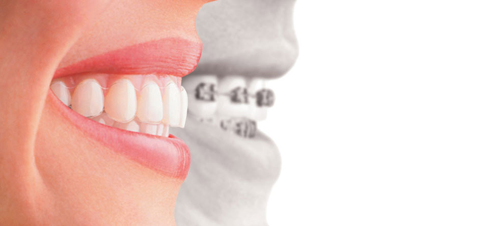 Orthodontic Treatment